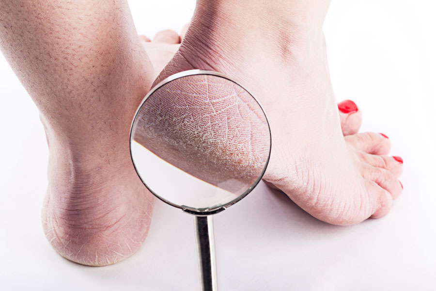 7 Ways to Get Rid of Cracked Heels Fast: & 2 Amazing Products to Soften Feet
