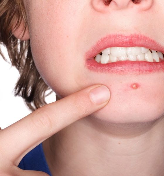 Get Rid of Acne Fast: Proven Methods to Banish a Pimple Quickly