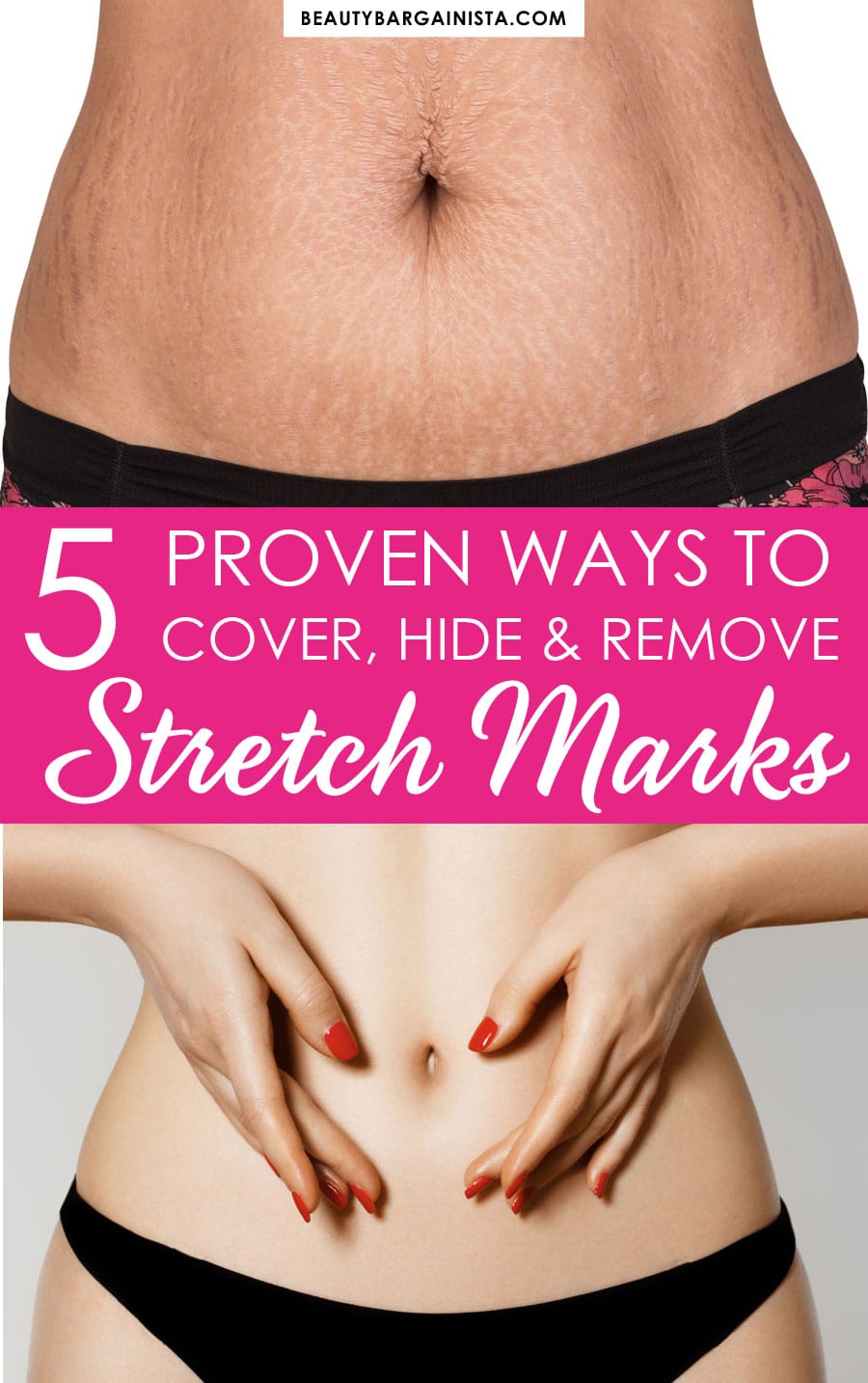 how to hide, cover and remove stretch marks